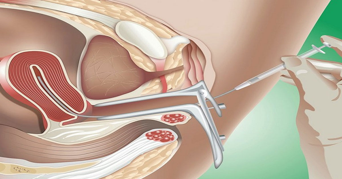 Fertility Treatment Intrauterine Insemination [IUI] in Vikhroli